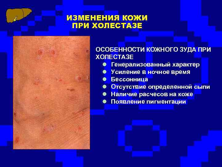 ИЗМЕНЕНИЯ КОЖИ ПРИ ХОЛЕСТАЗЕ ОСОБЕННОСТИ КОЖНОГО ЗУДА ПРИ ХОЛЕСТАЗЕ l Генерализованный характер l Усиление