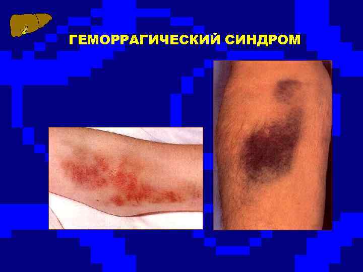 ГЕМОРРАГИЧЕСКИЙ СИНДРОМ 
