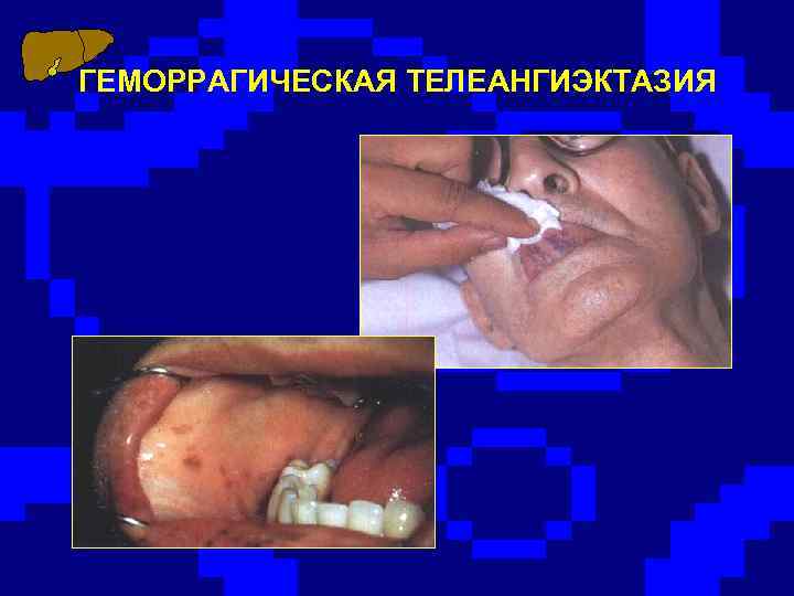 ГЕМОРРАГИЧЕСКАЯ ТЕЛЕАНГИЭКТАЗИЯ 