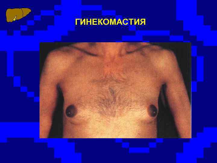 ГИНЕКОМАСТИЯ 