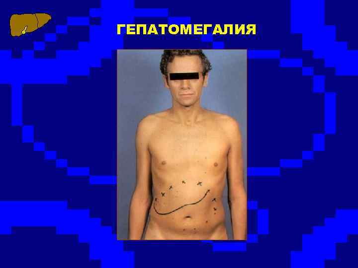 ГЕПАТОМЕГАЛИЯ 