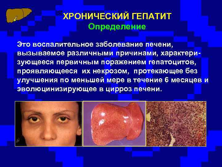ХРОНИЧЕСКИЙ ГЕПАТИТ Определение Это воспалительное заболевание печени, вызываемое различными причинами, характеризующееся первичным поражением гепатоцитов,