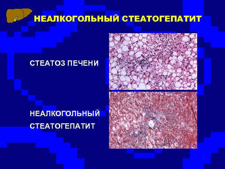 НЕАЛКОГОЛЬНЫЙ СТЕАТОГЕПАТИТ СТЕАТОЗ ПЕЧЕНИ НЕАЛКОГОЛЬНЫЙ СТЕАТОГЕПАТИТ 