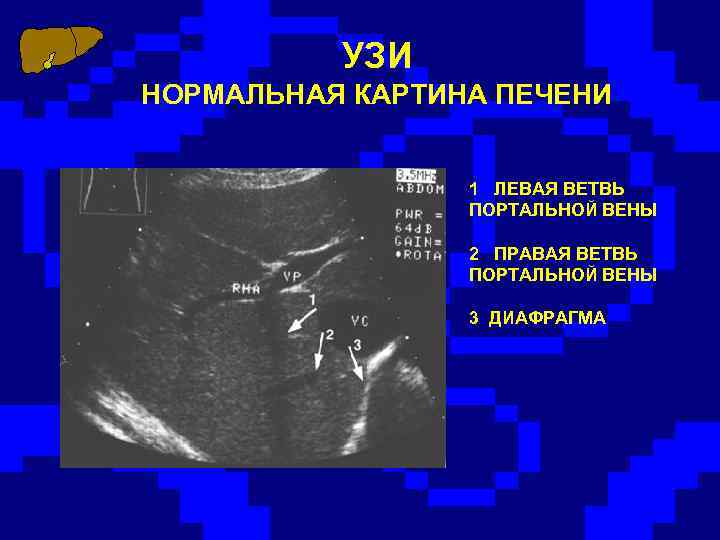 УЗИ НОРМАЛЬНАЯ КАРТИНА ПЕЧЕНИ 1 ЛЕВАЯ ВЕТВЬ ПОРТАЛЬНОЙ ВЕНЫ 2 ПРАВАЯ ВЕТВЬ ПОРТАЛЬНОЙ ВЕНЫ