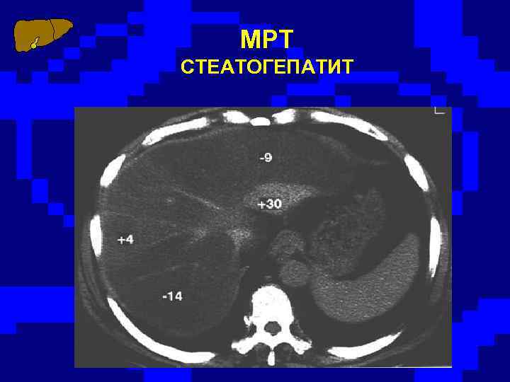 МРТ СТЕАТОГЕПАТИТ 