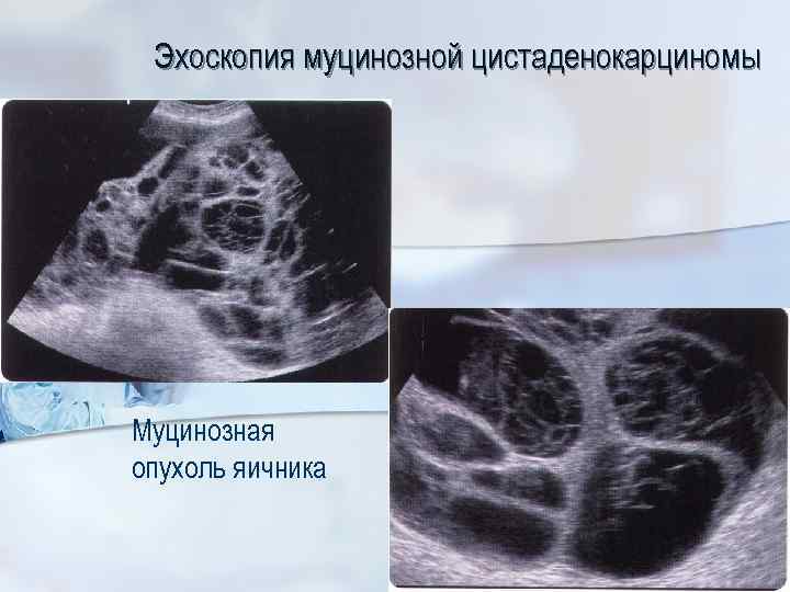 Муцинозная цистаденома поджелудочной железы. Цистаденокарцинома яичника кт. Папиллярная цистаденома яичника. Муцинозная цистаденома яичника.