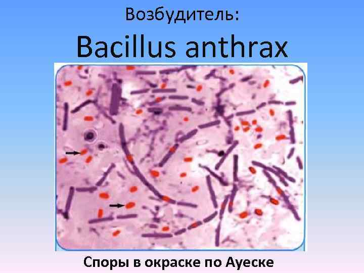 Возбудитель: Bacillus anthrax Споры в окраске по Ауеске 