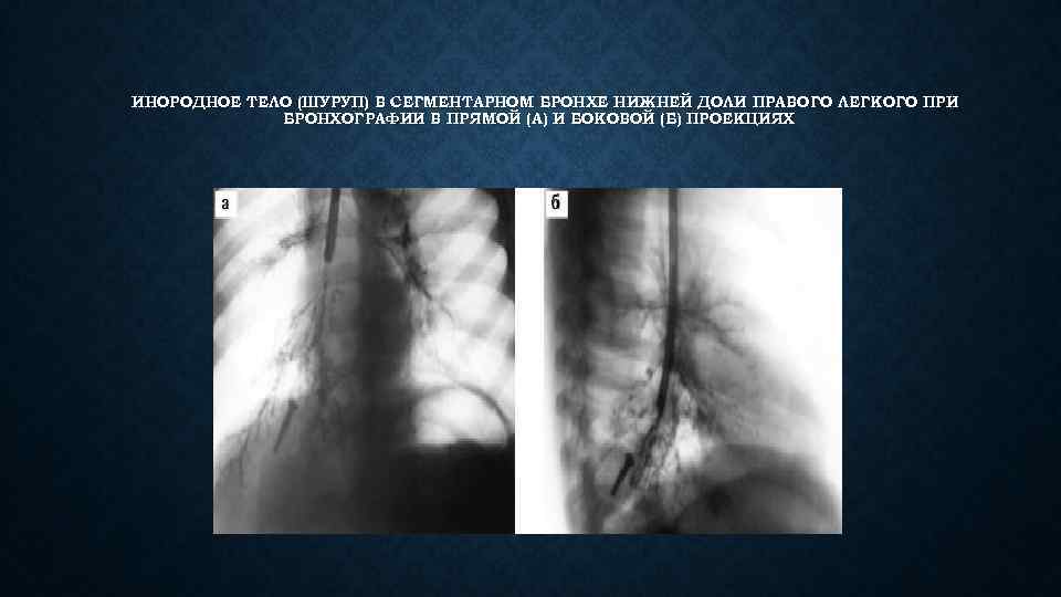 ИНОРОДНОЕ ТЕЛО (ШУРУП) В СЕГМЕНТАРНОМ БРОНХЕ НИЖНЕЙ ДОЛИ ПРАВОГО ЛЕГКОГО ПРИ БРОНХОГРАФИИ В ПРЯМОЙ