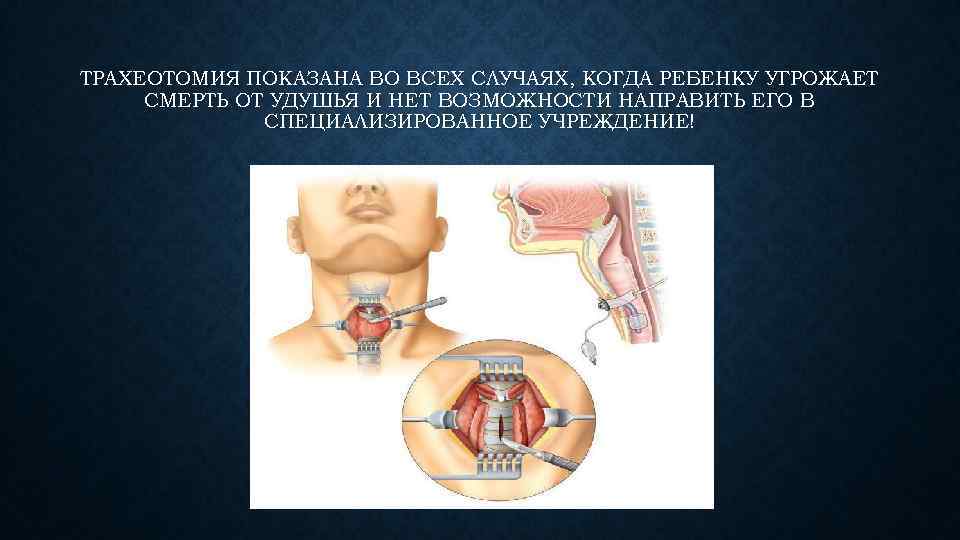 ТРАХЕОТОМИЯ ПОКАЗАНА ВО ВСЕХ СЛУЧАЯХ, КОГДА РЕБЕНКУ УГРОЖАЕТ СМЕРТЬ ОТ УДУШЬЯ И НЕТ ВОЗМОЖНОСТИ