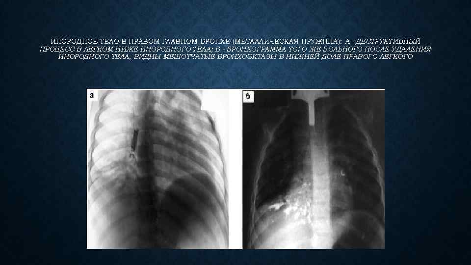 ИНОРОДНОЕ ТЕЛО В ПРАВОМ ГЛАВНОМ БРОНХЕ (МЕТАЛЛИЧЕСКАЯ ПРУЖИНА): А - ДЕСТРУКТИВНЫЙ ПРОЦЕСС В ЛЕГКОМ