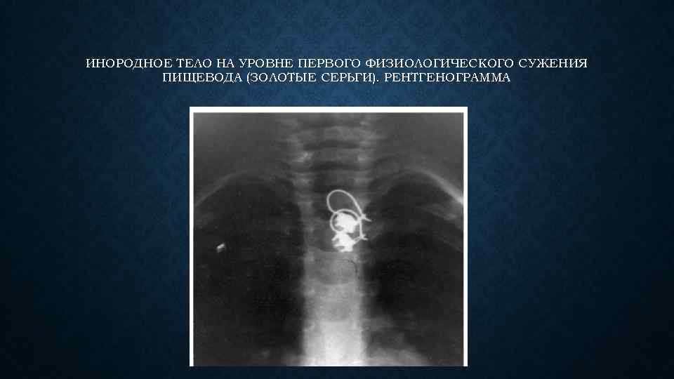 ИНОРОДНОЕ ТЕЛО НА УРОВНЕ ПЕРВОГО ФИЗИОЛОГИЧЕСКОГО СУЖЕНИЯ ПИЩЕВОДА (ЗОЛОТЫЕ СЕРЬГИ). РЕНТГЕНОГРАММА 