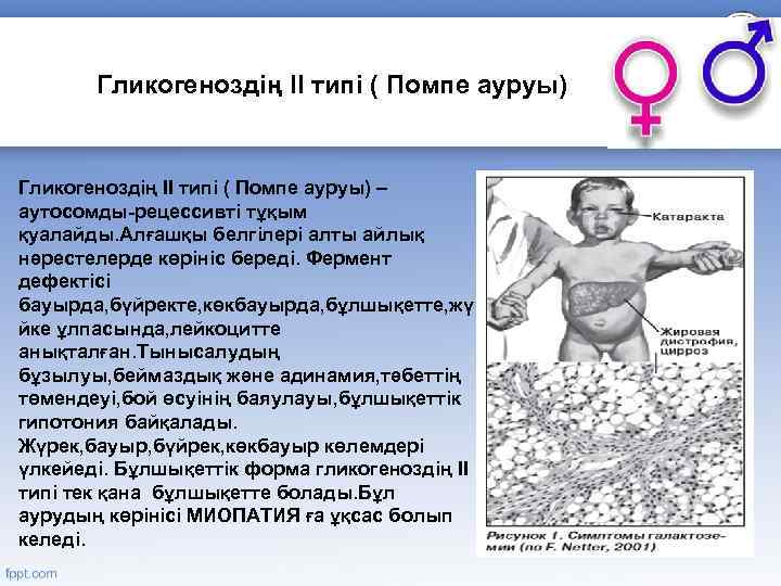 Гликогеноздің II типі ( Помпе ауруы) – аутосомды-рецессивті тұқым қуалайды. Алғашқы белгілері алты айлық