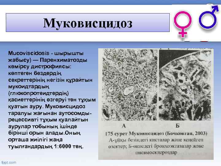 Муковисцидоз Мuсоviscidosis - шырышты жабысу) — Паренхиматозды көмірсу дистрофиясы: көптеген бездердің секреттерінің негізін құрайтын