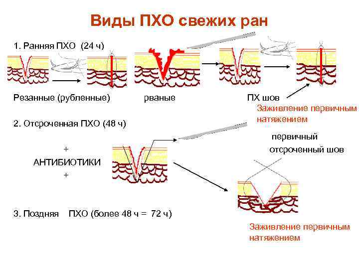 Виды ПХО свежих ран 1. Ранняя ПХО (24 ч) Резанные (рубленные) рваные 2. Отсроченная