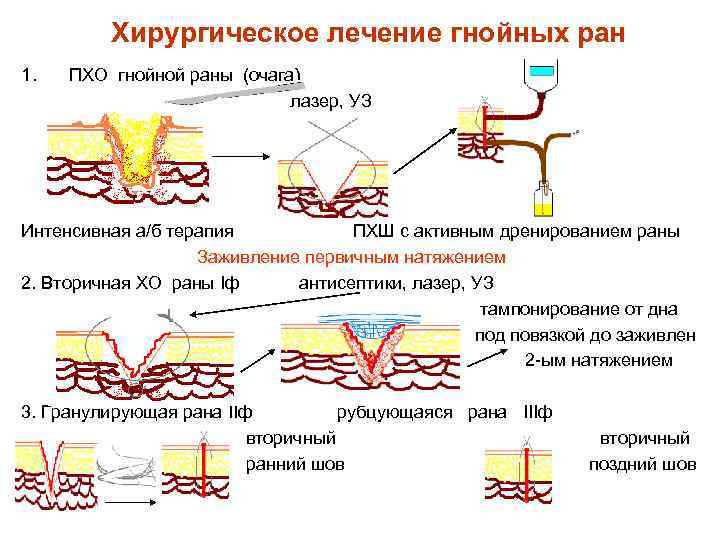 Хирургическое лечение гнойных ран 1. ПХО гнойной раны (очага) лазер, УЗ Интенсивная а/б терапия