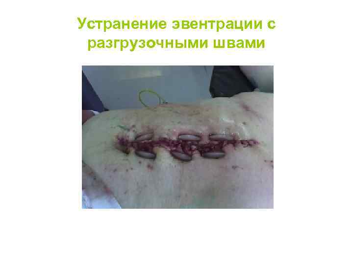 Устранение эвентрации с разгрузочными швами 