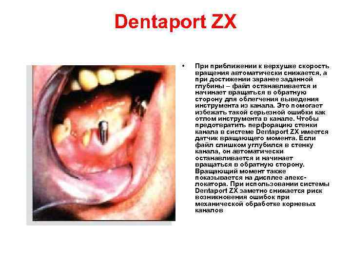 Dentaport ZX • При приближении к верхушке скорость вращения автоматически снижается, а при достижении