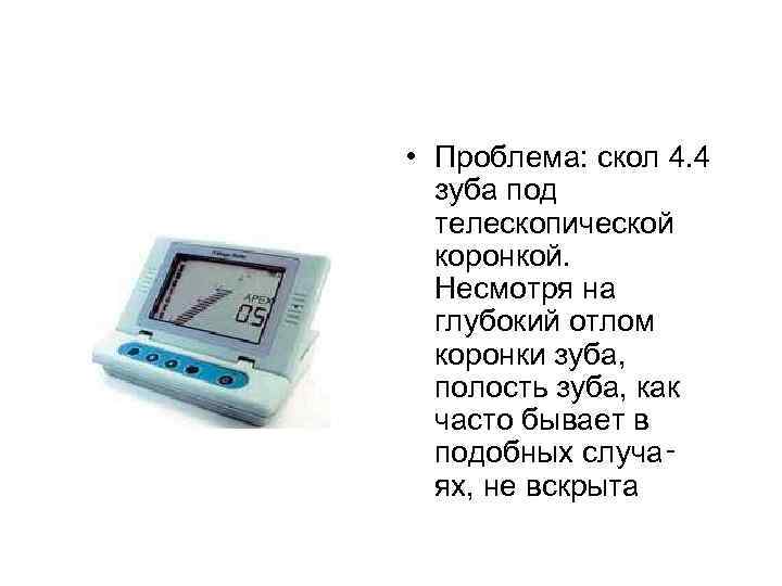  • Проблема: скол 4. 4 зуба под телескопической коронкой. Несмотря на глубокий отлом
