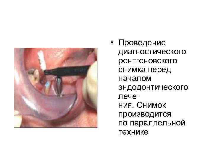  • Проведение диагностического рентгеновского снимка перед началом эндодонтического лече‑ ния. Снимок производится по