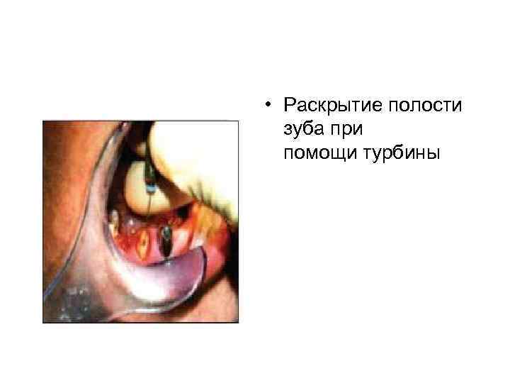  • Раскрытие полости зуба при помощи турбины 