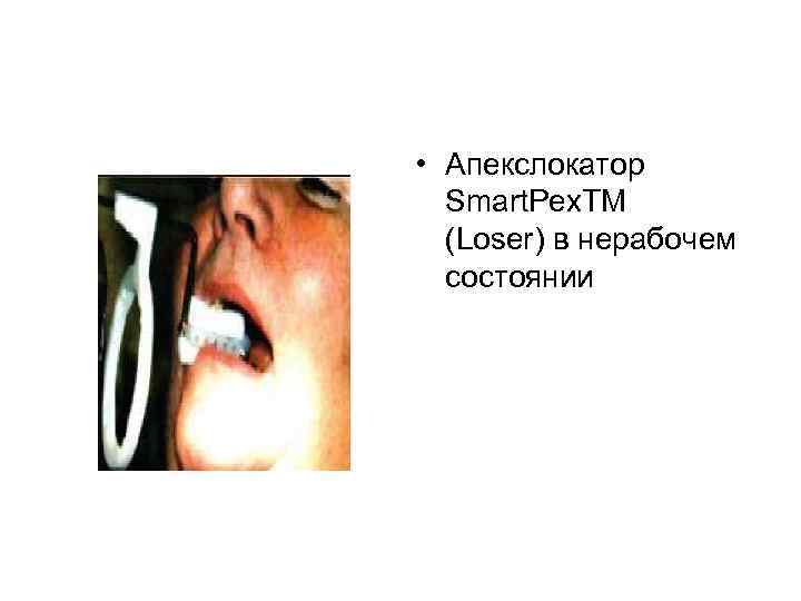  • Апекслокатор Smart. Pex. TM (Loser) в нерабочем состоянии 