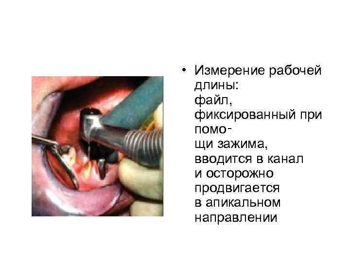  • Измерение рабочей длины: файл, фиксированный при помо‑ щи зажима, вводится в канал