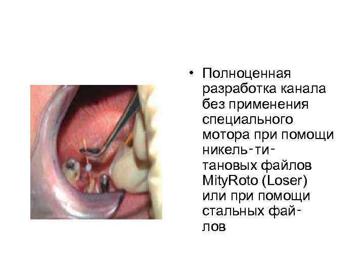  • Полноценная разработка канала без применения специального мотора при помощи никель‑ти‑ тановых файлов