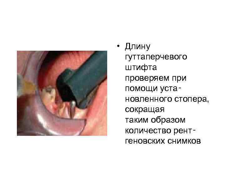  • Длину гуттаперчевого штифта проверяем при помощи уста‑ новленного стопера, сокращая таким образом