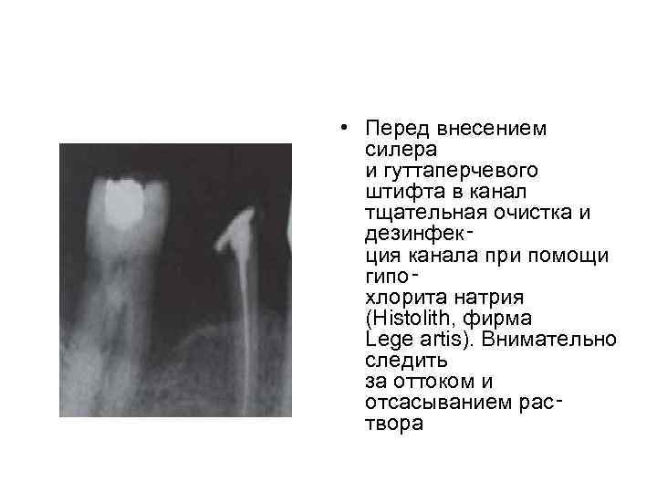  • Перед внесением силера и гуттаперчевого штифта в канал тщательная очистка и дезинфек‑