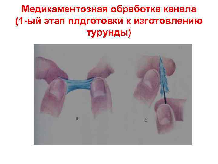 Медикаментозная обработка канала (1 -ый этап плдготовки к изготовлению турунды) 