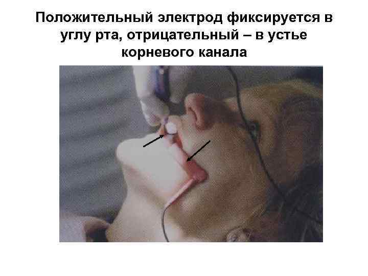 Положительный электрод фиксируется в углу рта, отрицательный – в устье корневого канала 