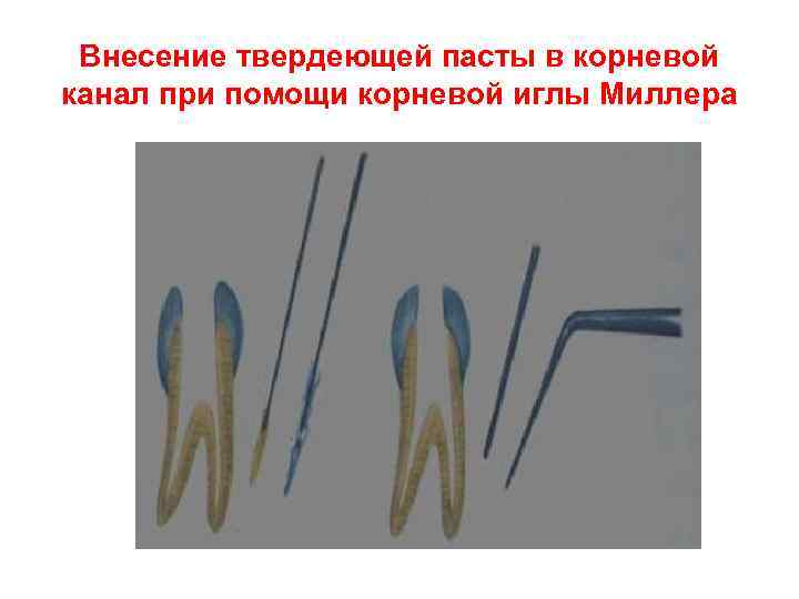 Внесение твердеющей пасты в корневой канал при помощи корневой иглы Миллера 