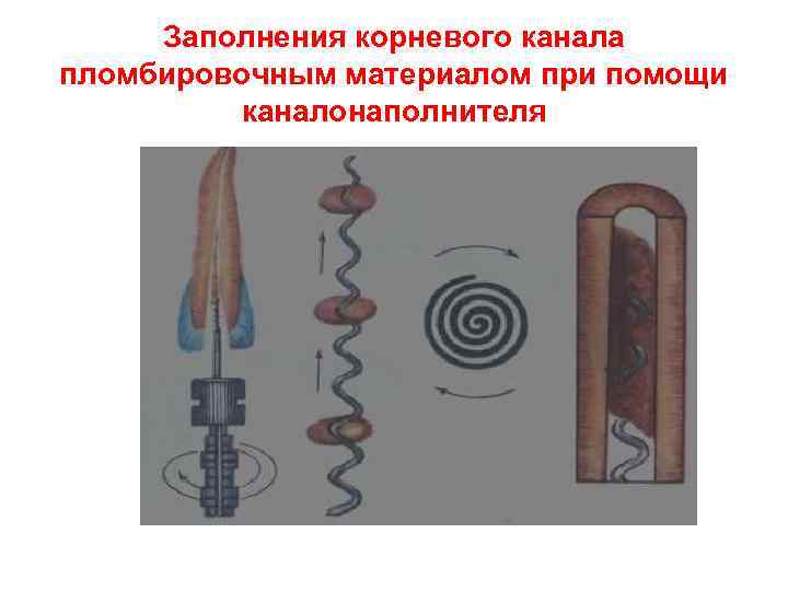 Заполнения корневого канала пломбировочным материалом при помощи каналонаполнителя 