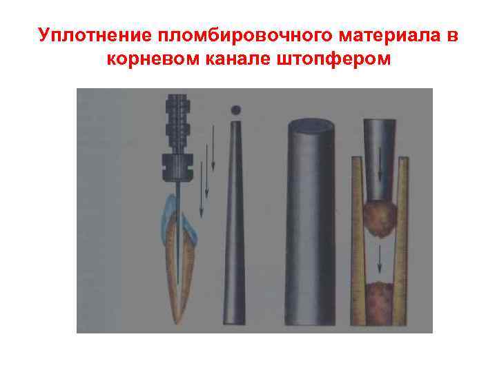 Уплотнение пломбировочного материала в корневом канале штопфером 