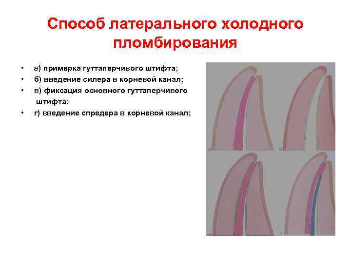 Способ латерального холодного пломбирования • • а) примерка гуттаперчивого штифта; б) введение силера в