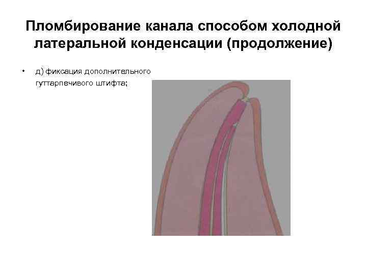 Пломбирование канала способом холодной латеральной конденсации (продолжение) • д) фиксация дополнительного гуттарпечивого штифта; 