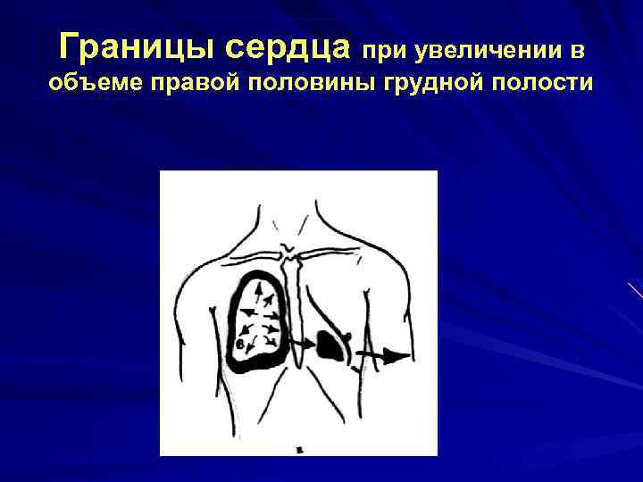 Границы сердца при увеличении в объеме правой половины грудной полости 