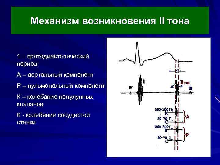 Механизм возникновения II тона 1 – протодиастолический период А – аортальный компонент Р –