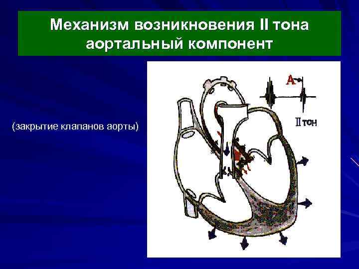 Механизм возникновения II тона аортальный компонент А – аортальный компонент (закрытие клапанов аорты) 