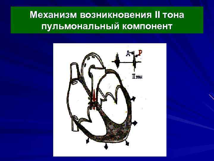 Механизм возникновения II тона пульмональный компонент 