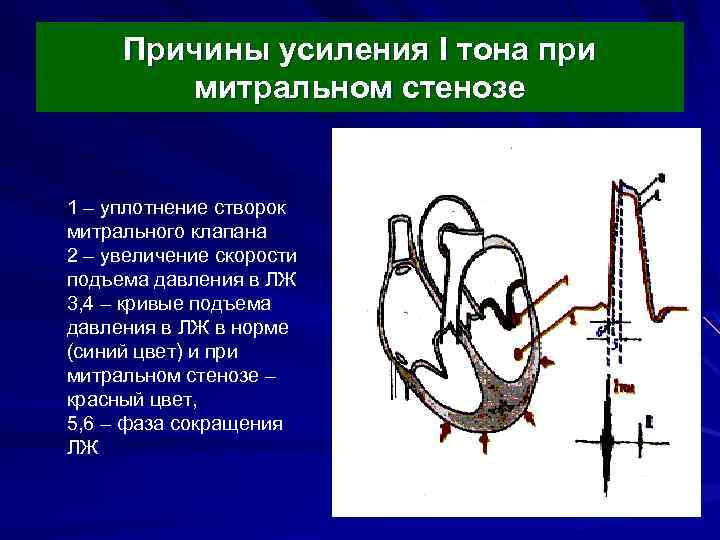 Причины усиления I тона при митральном стенозе 1 – уплотнение створок митрального клапана 2