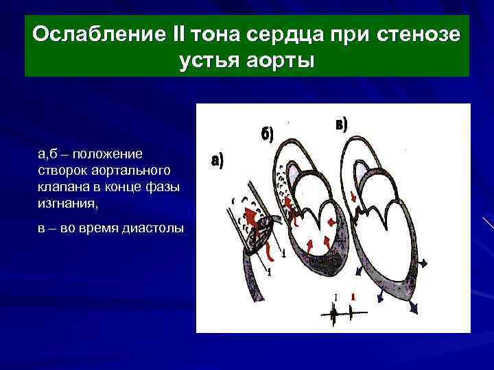 Ослабление II тона сердца при стенозе устья аорты а, б – положение створок аортального