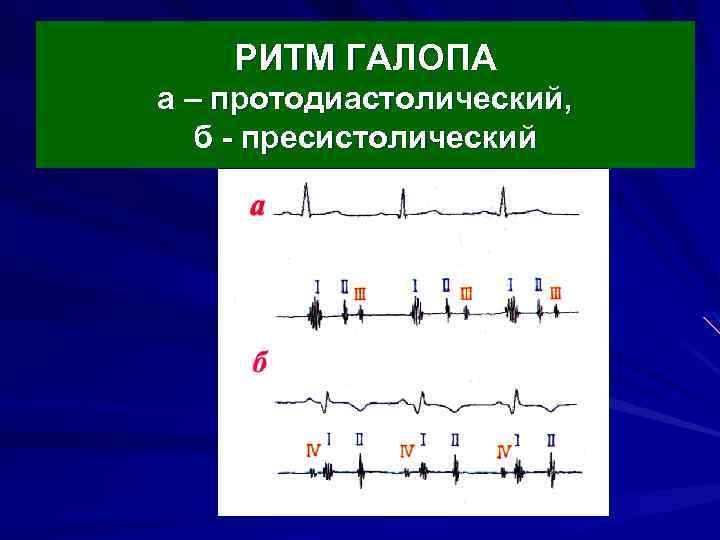 РИТМ ГАЛОПА а – протодиастолический, б - пресистолический 