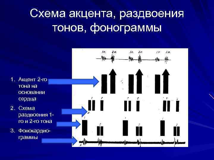 Схема акцента, раздвоения тонов, фонограммы 1. Акцент 2 -го тона на основании сердца 2.