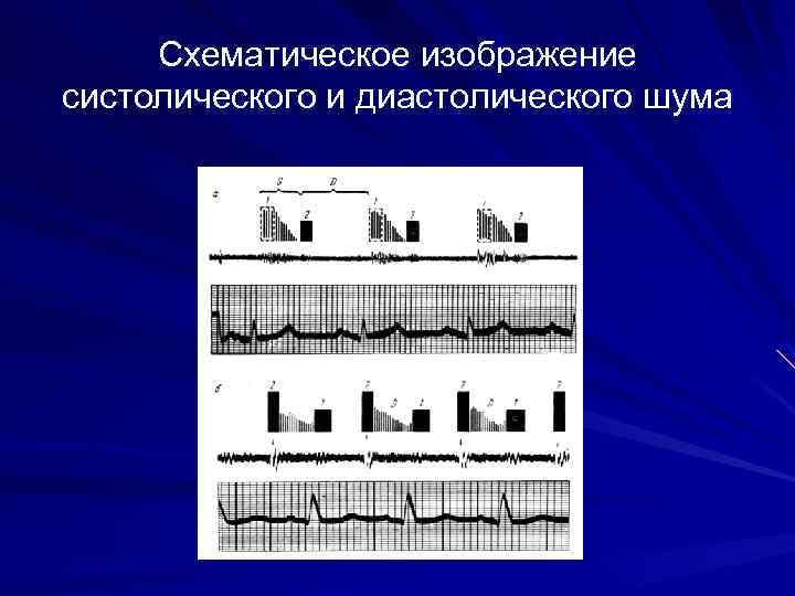 Схематическое изображение систолического и диастолического шума 