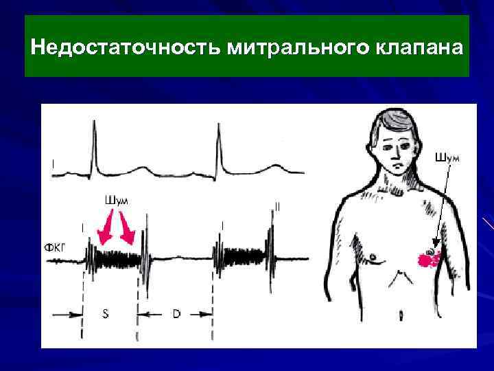 Недостаточность митрального клапана 