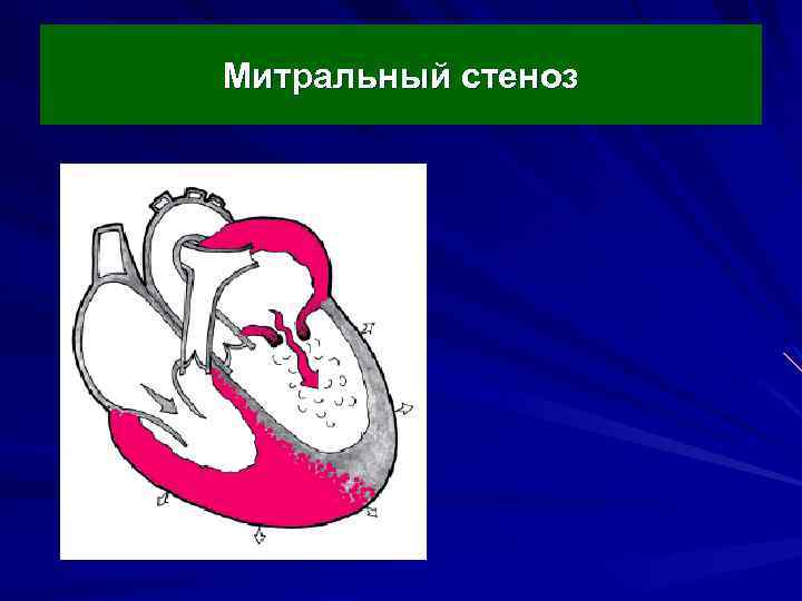 Аускультативная картина при митральном стенозе сердца включает на верхушке