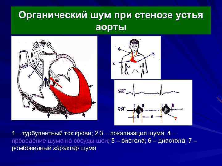 Аускультативная картина i тона сердца при стенозе устья аорты