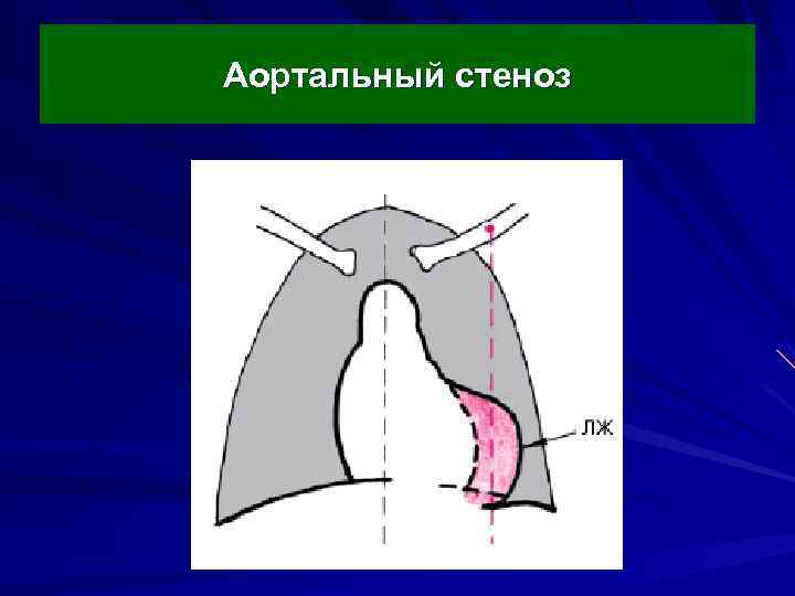 Аортальный стеноз 