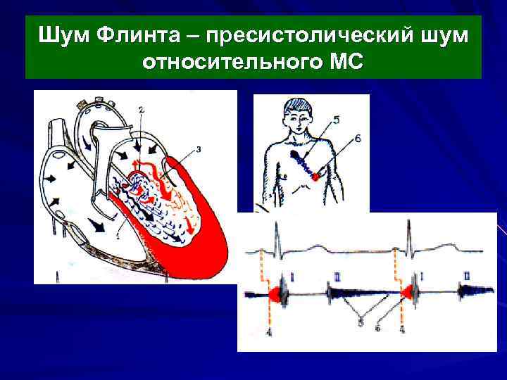 Шум Флинта – пресистолический шум относительного МС 